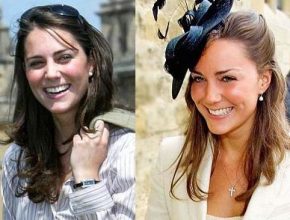 Kate Middleton before and after plastic surgery 4