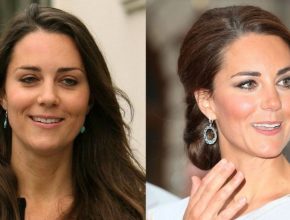 Kate Middleton before and after plastic surgery