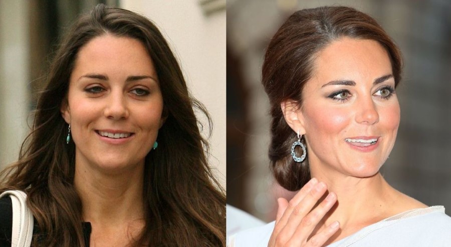 Kate Middleton before and after plastic surgery 