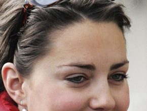 Kate Middleton before plastic surgery 9