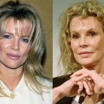 Kim Basinger before and after plastic surgery 10