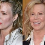 Kim Basinger before and after plastic surgery 39