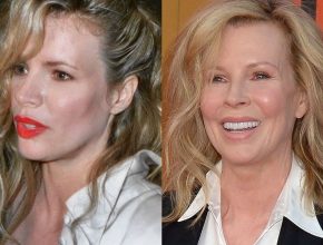 Kim Basinger before and after plastic surgery 39