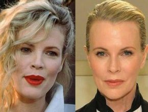 Kim Basinger before and after plastic surgery 6