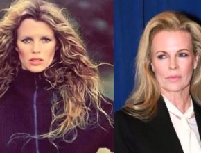 Kim Basinger before and after plastic surgery