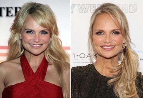 Kristin Chenoweth before and after plastic surgery 