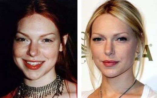 Laura Prepon before and after plastic surgery 