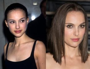 Natalie Portman before and after plastic surgery