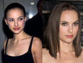 Natalie Portman before and after plastic surgery