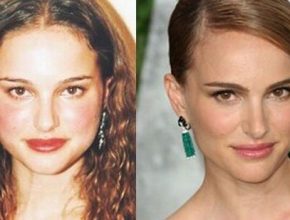 Natalie Portman before and after plastic surgery 33