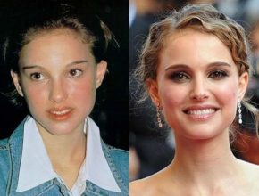 Natalie Portman before and after plastic surgery 34