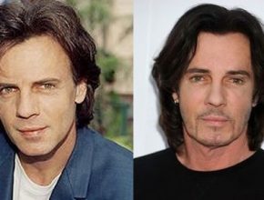 Rick Springfield before and after plastic surgery 3