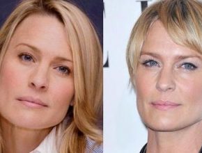 Robin Wright before and after plastic surgery