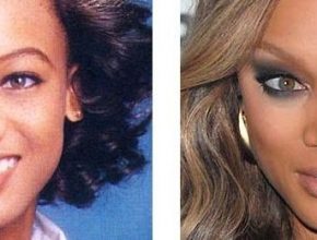 Tyra Banks before and after plastic surgery 22