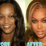 Tyra Banks before and after plastic surgery 24