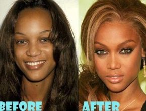 Tyra Banks before and after plastic surgery 24