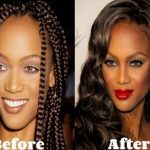 Tyra Banks before and after plastic surgery 25