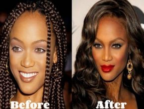 Tyra Banks before and after plastic surgery 25