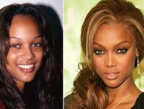 Tyra Banks before and after plastic surgery