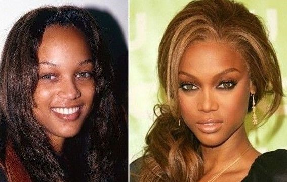 Tyra Banks before and after plastic surgery