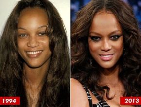 Tyra Banks plastic surgery before and after 3