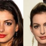 Anne Hathaway before and after plastic surgery 22