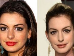 Anne Hathaway before and after plastic surgery 22