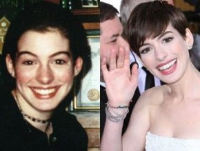 Anne Hathaway before and after plastic surgery 39