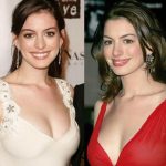 Anne Hathaway Plastic Surgery 31