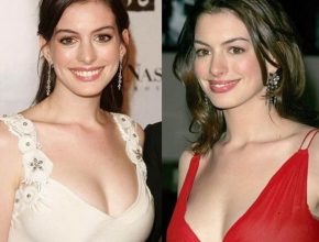 Anne Hathaway Plastic Surgery 31
