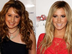 Ashley Tisdale before and after plastic surgery