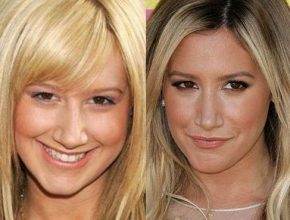 Ashley Tisdale before and after plastic surgery 20