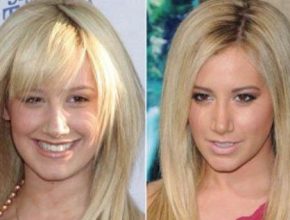 Ashley Tisdale before and after plastic surgery 9