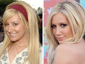 Ashley Tisdale plastic surgery 01