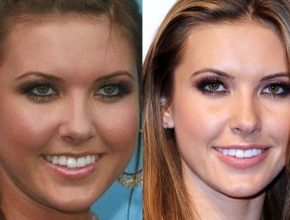 Audrina Patridge before and after plastic surgery