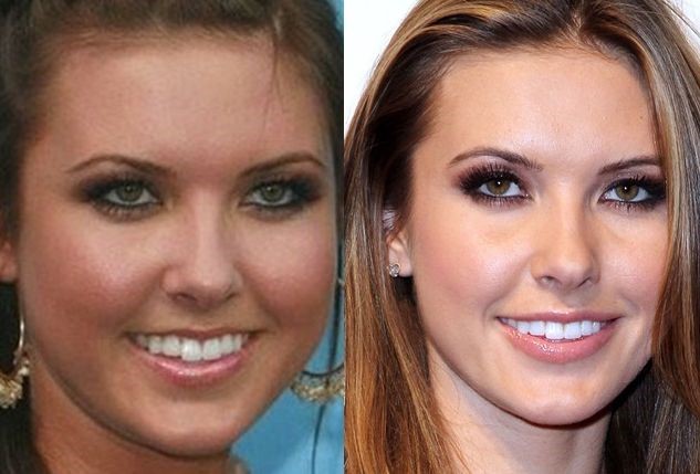 Audrina Patridge before and after plastic surgery