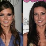 Audrina Patridge before and after plastic surgery 3