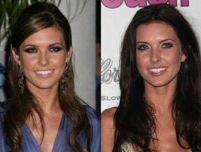 Audrina Patridge before and after plastic surgery 3