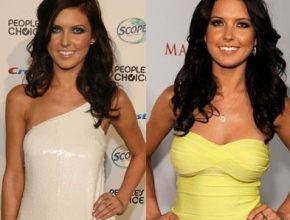 Audrina Patridge before and after plastic surgery 4
