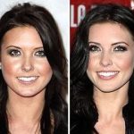 Audrina Patridge before and after plastic surgery 40