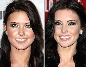 Audrina Patridge before and after plastic surgery 40