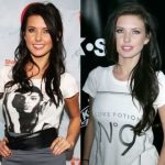 Audrina Patridge before and after plastic surgery 6