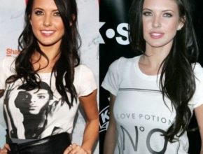 Audrina Patridge before and after plastic surgery 6