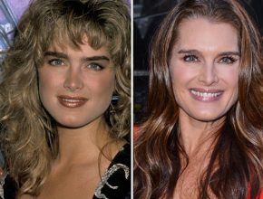 Brooke Shields before and after plastic surgery 01