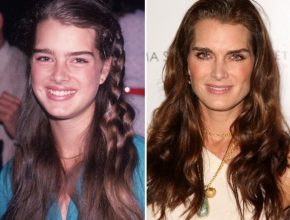 Brooke Shields before and after plastic surgery