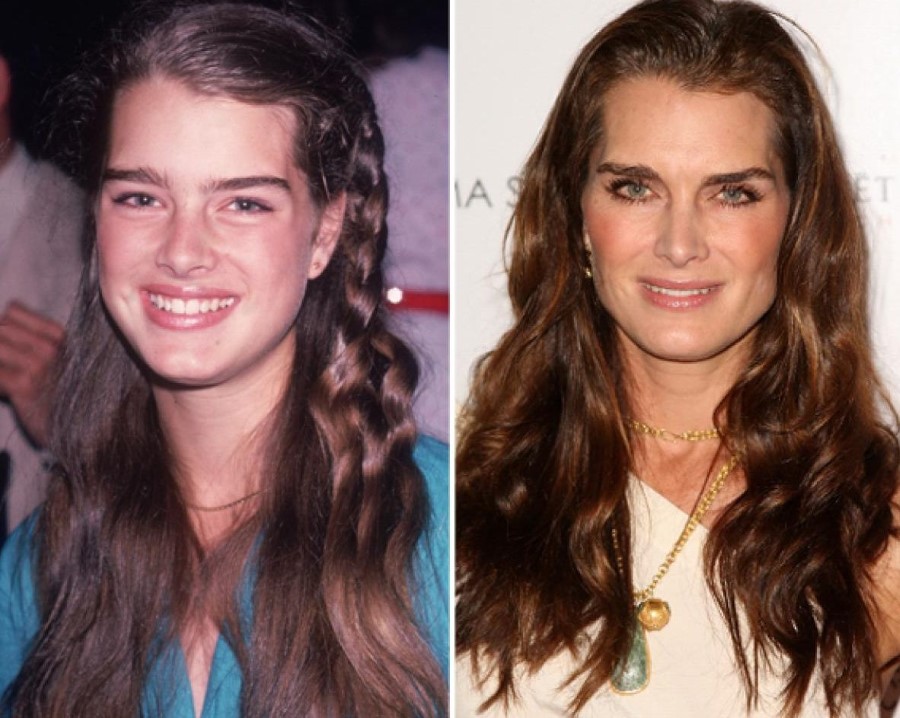 Brooke Shields before and after plastic surgery