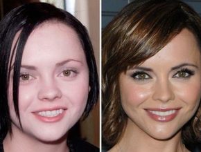 Christina Ricci before and after plastic surgery