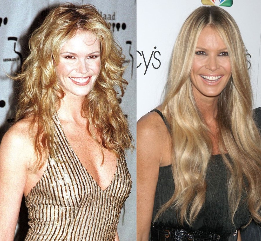 Elle Macpherson before and after plastic surgery