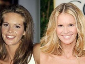 Elle Macpherson before and after plastic surgery 9