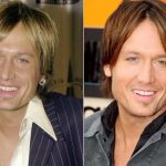 Keith Urban before and after plastic surgery 12